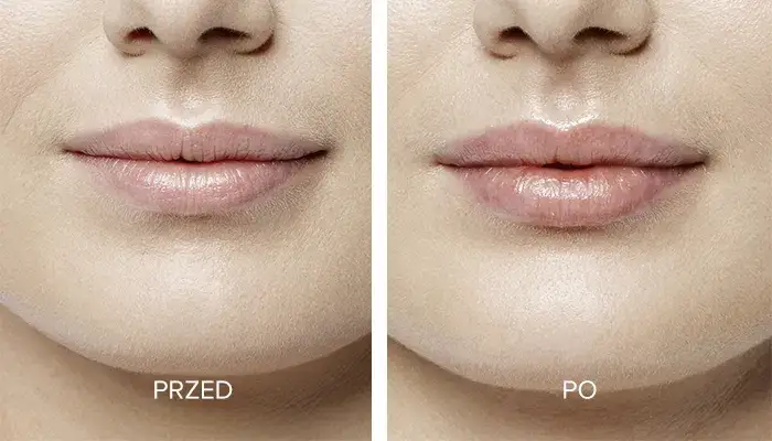 Ile kosztuje 1 ml kwasu hialuronowego w usta? Sprawdź ceny w klinikach