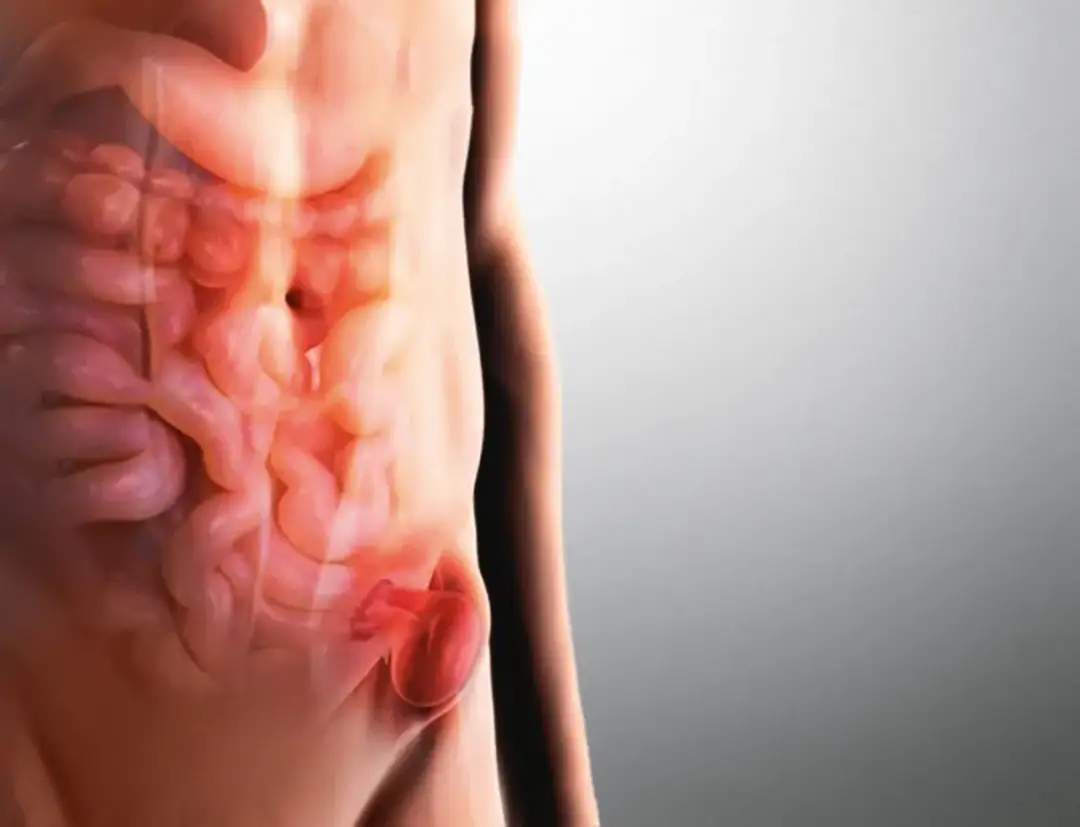 Przepuklina: do jakiego lekarza się udać? Poradnik pacjenta