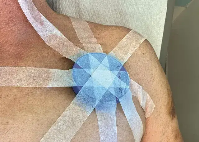 Wymiana baterii w rozruszniku serca - jak wygląda zabieg?