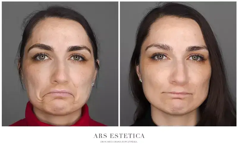 Botoks na czoło: Ile jednostek dla naturalnego efektu? Koszt