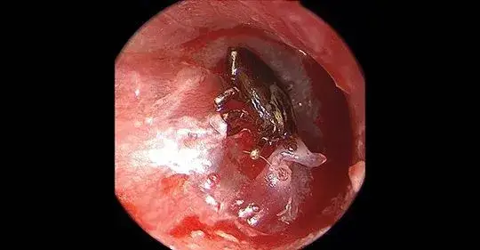 Kleszcz w uchu człowieka – objawy, zagrożenia i jak go bezpiecznie usunąć