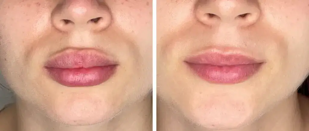 Usuwanie kwasu hialuronowego z ust: Domowe mity czy hialuronidaza?