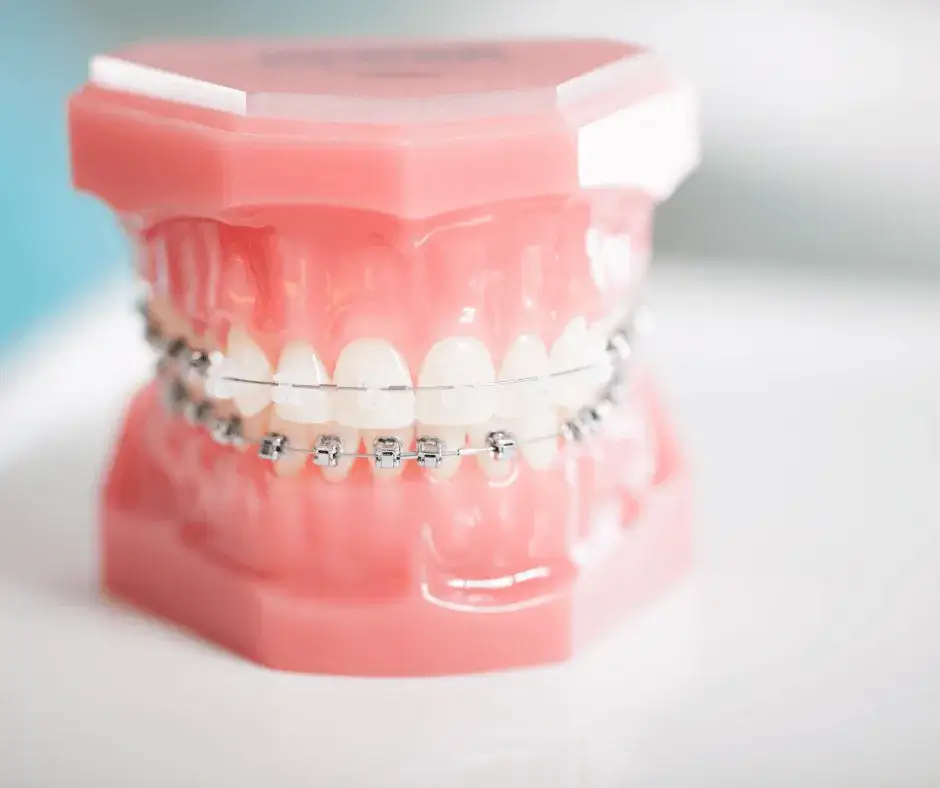 Jak wyglądają aparaty na zęby? Różnice, estetyka i komfort noszenia