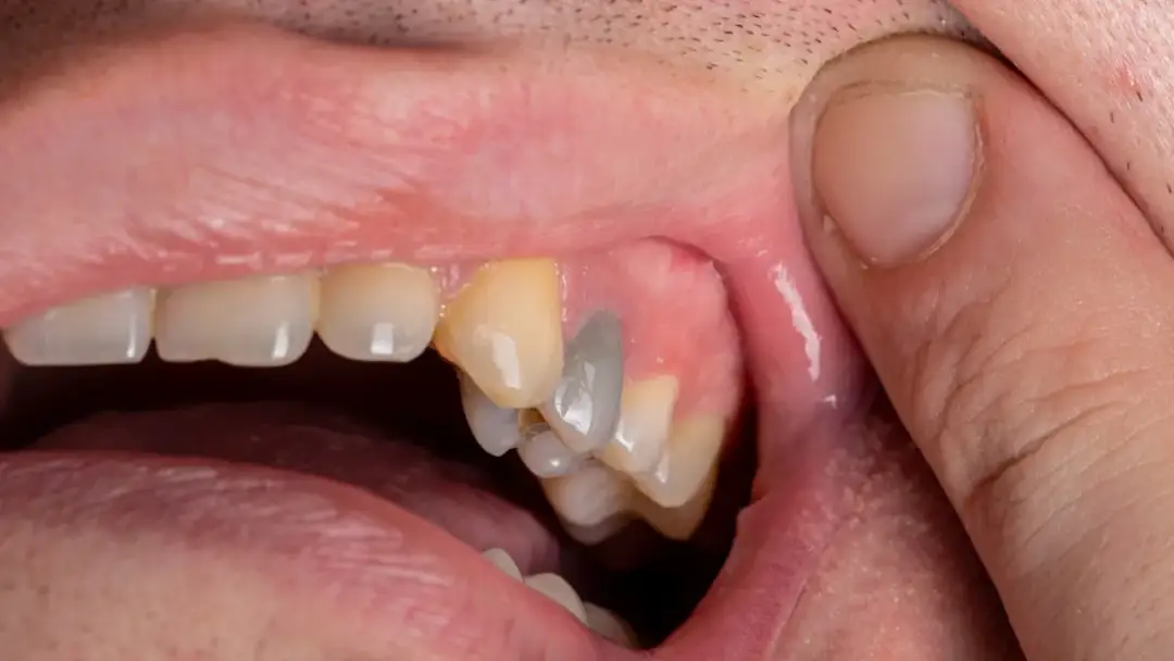 Jak długo trwa ból przy zapaleniu miazgi zęba? Poznaj ważne informacje