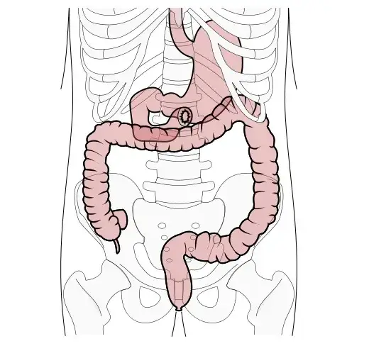 Zaburzenia wchłaniania tłuszczów objawy – nie ignoruj tych sygnałów