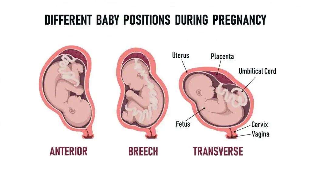 Położenie miednicowe a objawy porodu - co musisz wiedzieć?