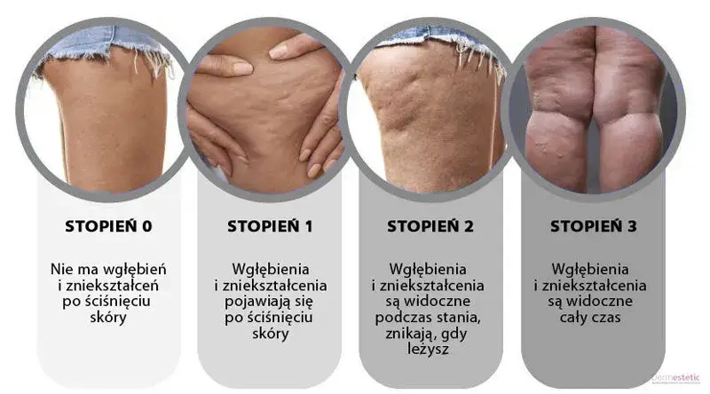 Jak pozbyć się cellulitu? Kompletny przewodnik po domowych i zabiegach