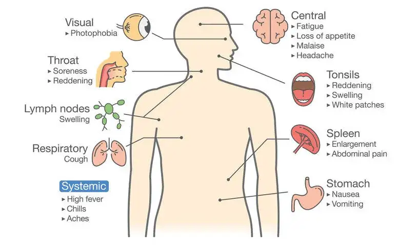 Síntoma de la mononucleosis: identifica los signos y evita complicaciones