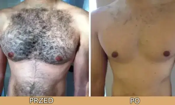 Co to jest epilacja i jak skutecznie usunąć niechciane owłosienie?