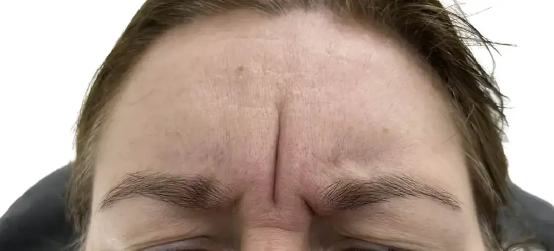 Gdzie kupić botox Allergan? Sprawdzone miejsca i ważne informacje