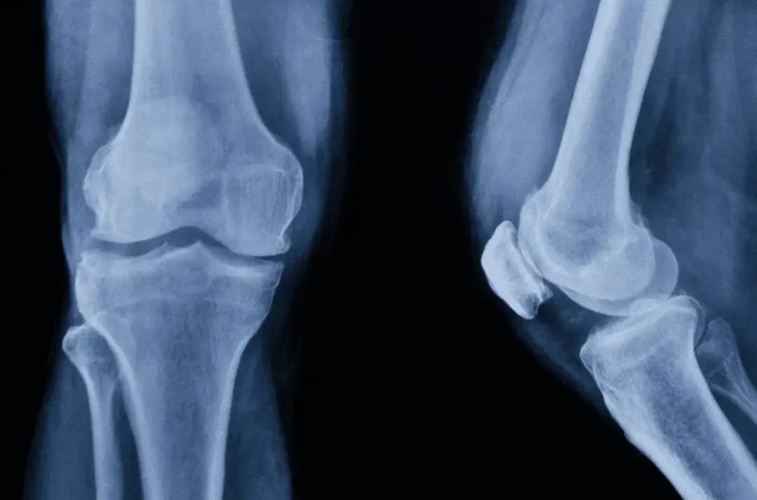 Anatomia kolana: Kompendium wiedzy o budowie i funkcjach