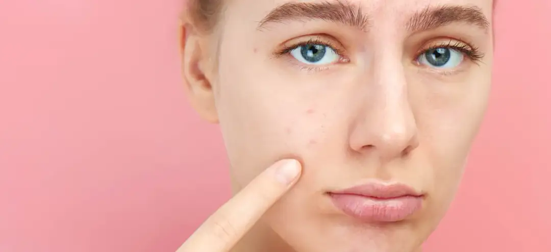 Jakie badania hormonów przy trądziku mogą zmienić Twoje leczenie?