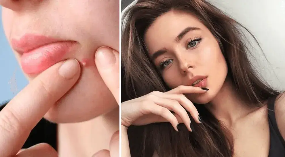 Skuteczne sposoby na pryszcze: jak szybko je wyleczyć i zapobiec