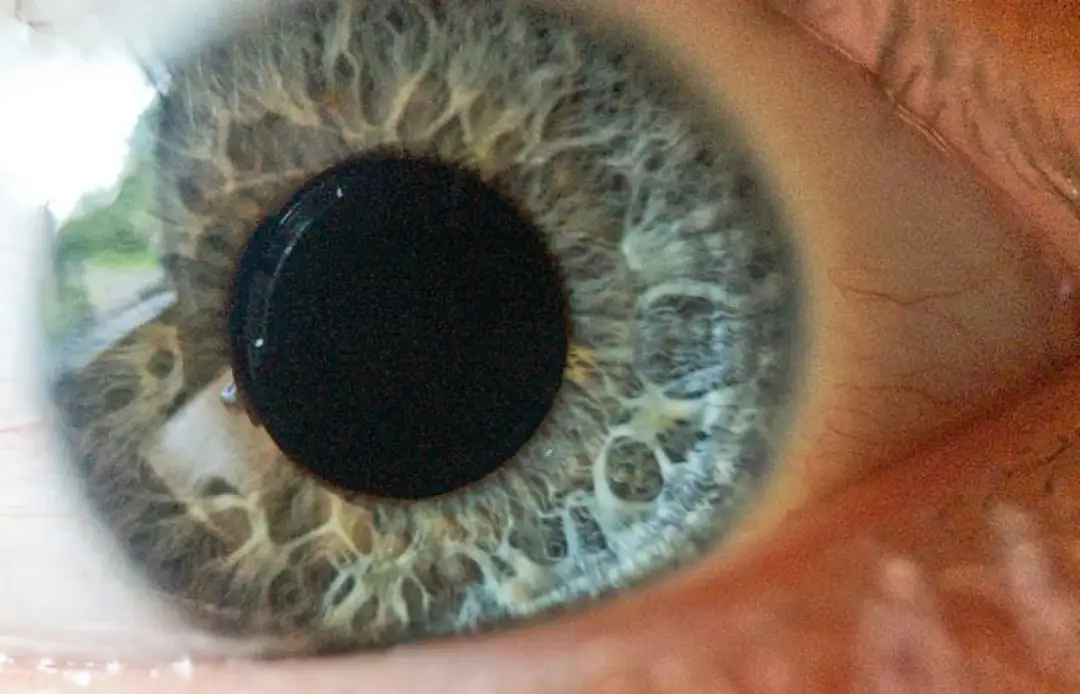 Jak szybko postępuje jaskra i jak uniknąć utraty wzroku