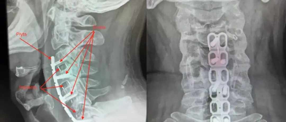 Dyskopatia szyjna C6-C7 objawy: Co powinieneś wiedzieć o bólu szyi