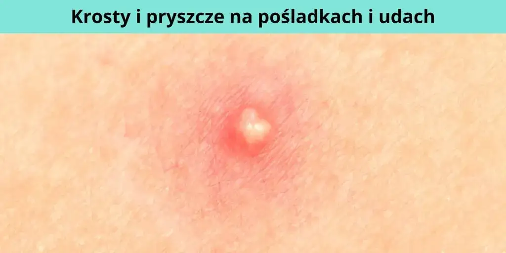 Co oznaczają pryszcze w poszczególnych miejscach i jak je leczyć