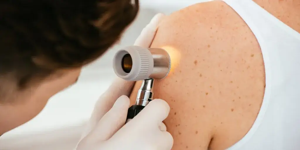 Pryszcze na plecach: Od czego? Poznaj przyczyny i skuteczne rozwiązania