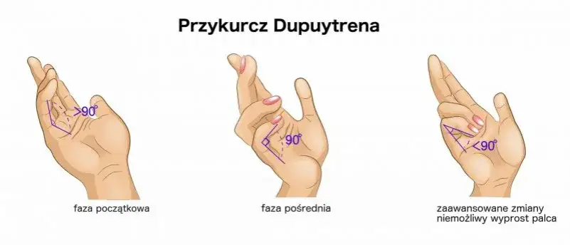 Przykurcz dupuytrena do jakiego lekarza? Sprawdź, kogo wybrać