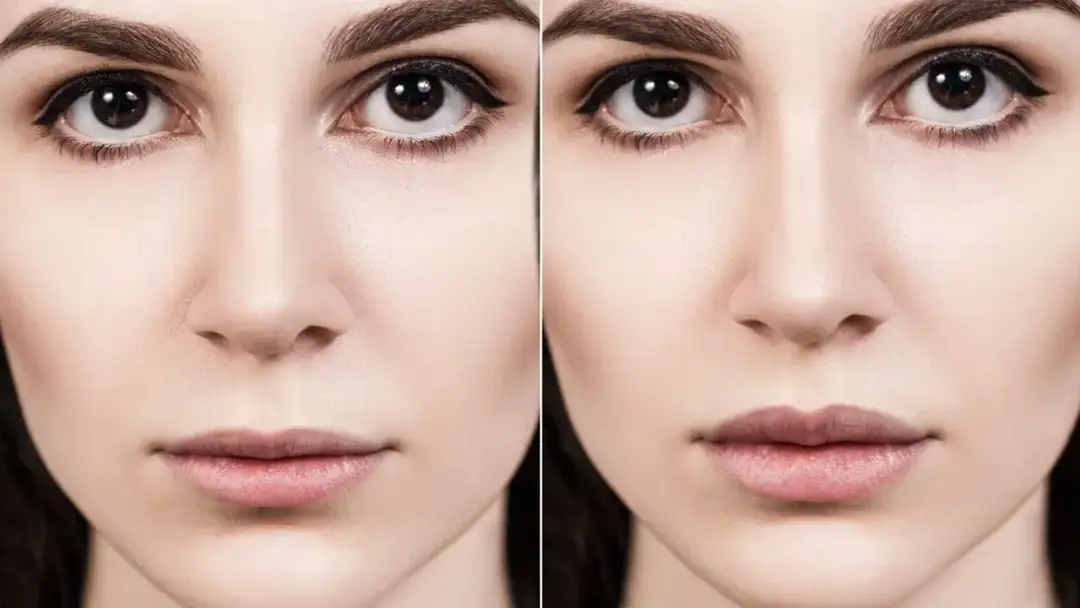 Usta: botoks czy kwas hialuronowy - co wybrać dla idealnego efektu?