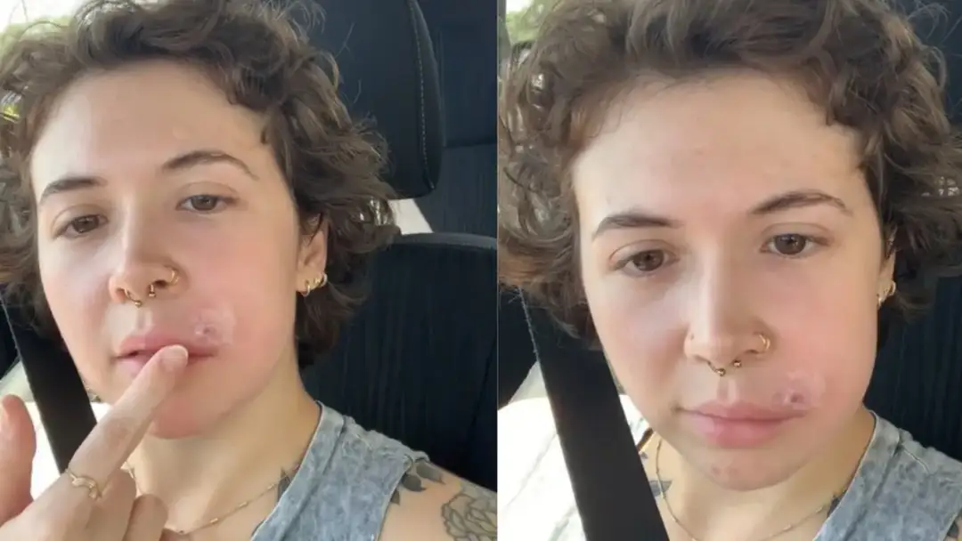 Jak zmniejszyć zaczerwienienie pryszcza? Moje szybkie triki!