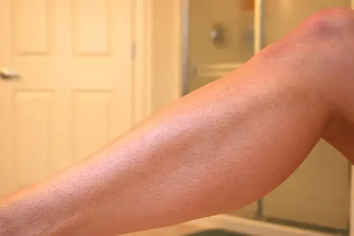 Co na truskawkowe nogi: skuteczne metody na gładką skórę