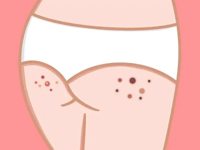 Jak pozbyć się pryszczy na pośladkach - skuteczne metody i porady