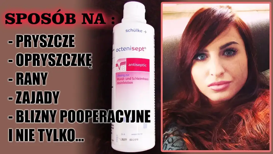 Co na wycisniete pryszcze: skuteczne metody na podrażnienia i blizny