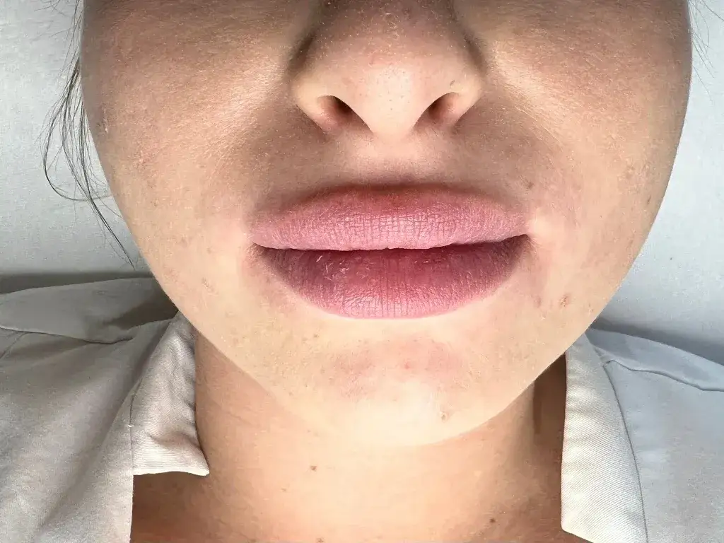 Powiększanie ust w Poznaniu: gdzie znaleźć najlepsze kliniki?