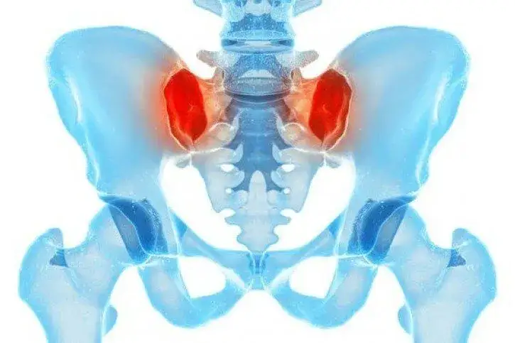 Jakie leczenie i lekarz przy zapaleniu stawu krzyżowo-biodrowego?
