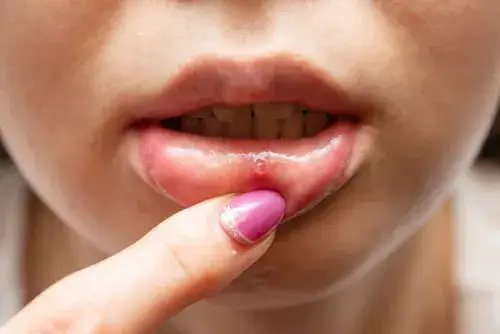 Opryszczkowe zapalenie jamy ustnej u dzieci - ile trwa i jak złagodzić objawy