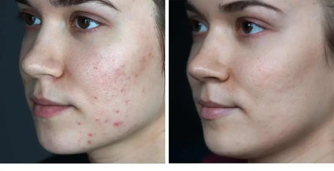 Skuteczne metody na blizny po pryszczach – jak je zredukować?