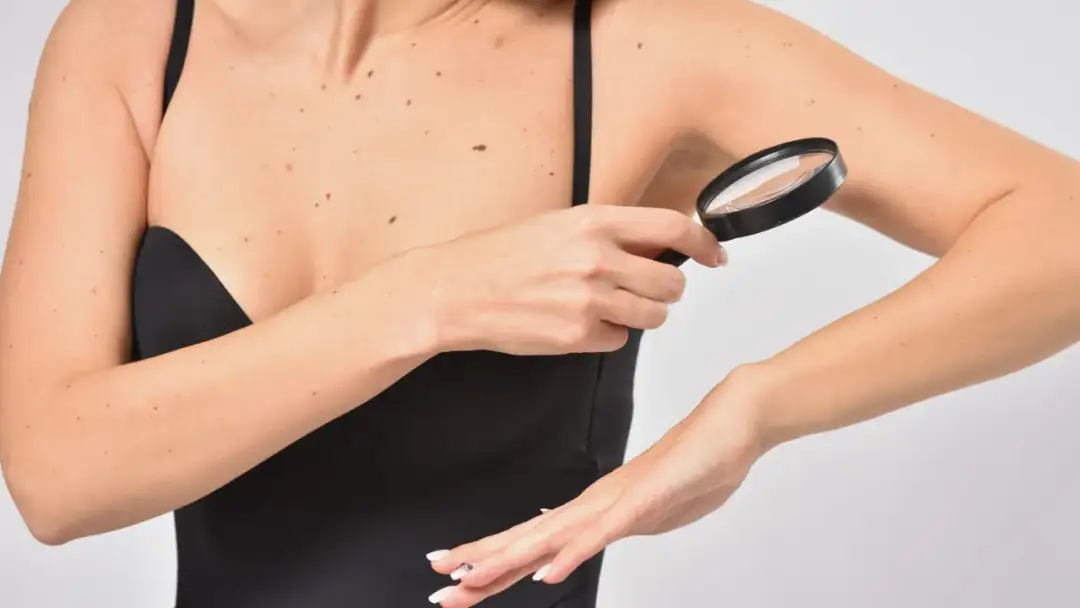 Skąd się biorą pieprzyki? Poznaj przyczyny i rodzaje zmian skórnych