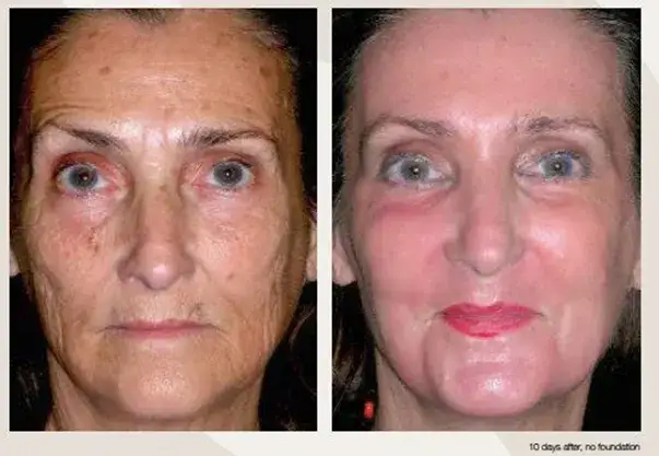 Peeling fenolowy ile się goi? Poznaj czas regeneracji skóry