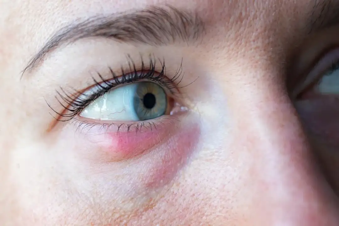 Jak leczyć jęczmień na oku? Domowe sposoby, maści, kiedy do lekarza