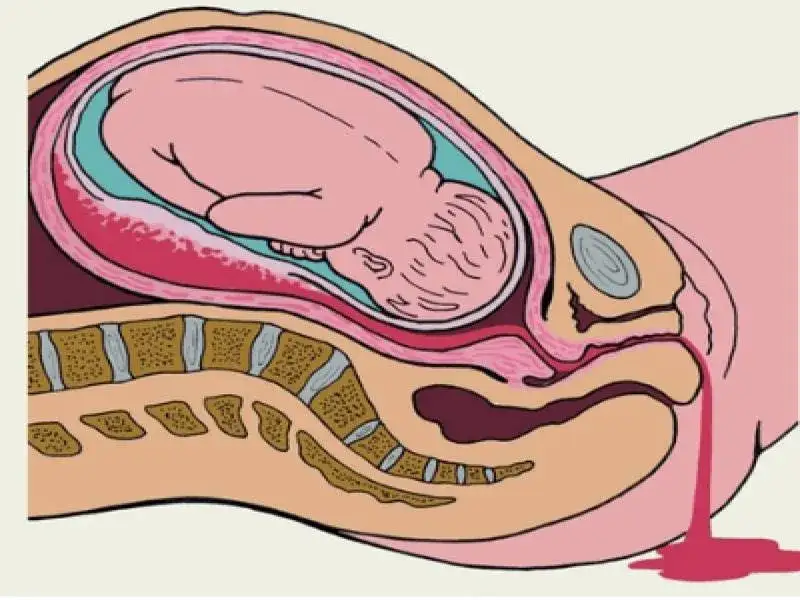 Pęknięcie krwiaka w ciąży objawy – co musisz wiedzieć, by nie przegapić