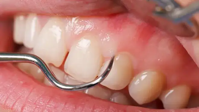 Boli dziąsło? Szybka ulga, przyczyny i kiedy musisz do dentysty.