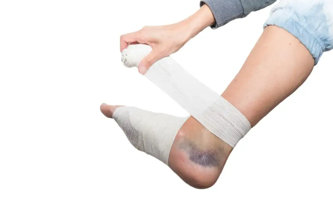 Skręcenie kostki gdzie się udać? Sprawdź, jak uniknąć powikłań