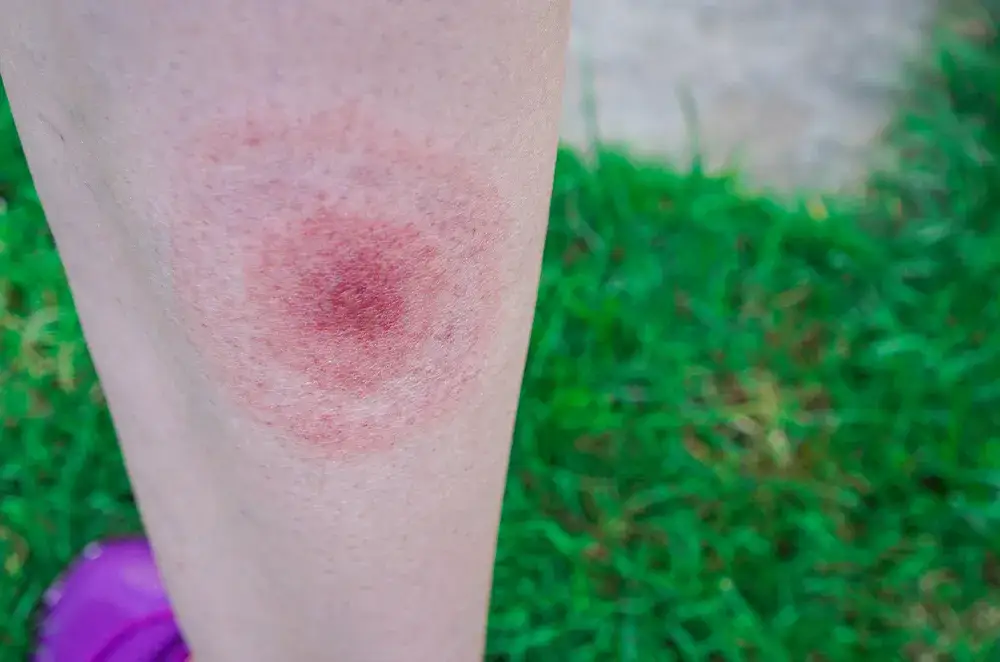 Jak wygląda miejsce po kleszczu? Objawy, zmiany skórne i ryzyko boreliozy