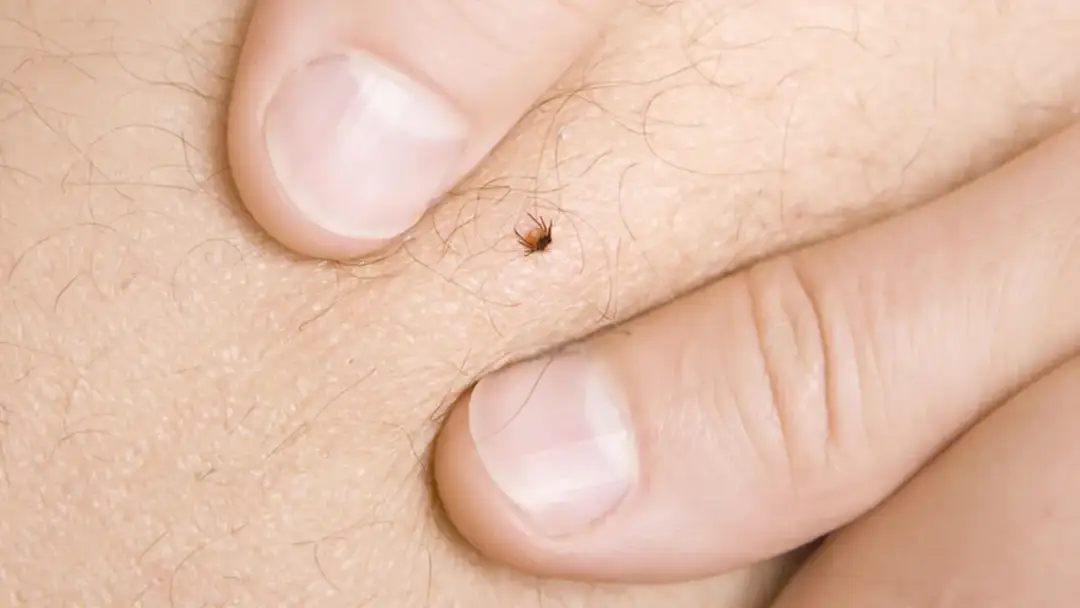 Jak bezpiecznie usunąć kleszcza bez pęsety – skuteczne metody i błędy, których unikać