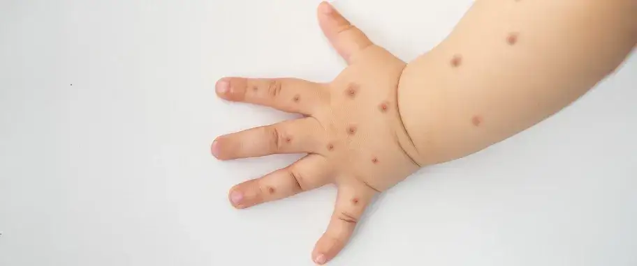 Mięczak zakaźny a wizyta na basenie - co musisz wiedzieć przed kąpielą