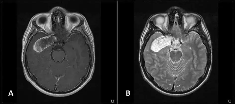 Czy torbiel u niemowlaka się wchłonie? Prawda o cystach i ich losie