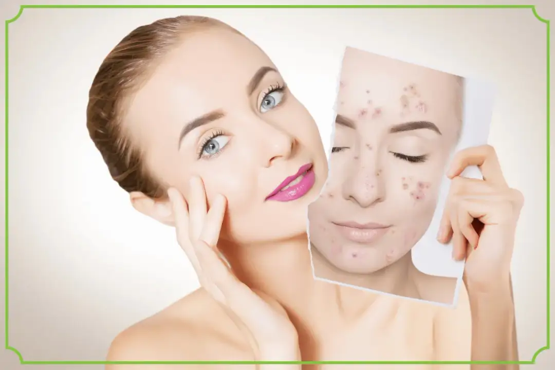 Skuteczne suplementy na trądzik: poznaj 8 najlepszych składników do walki