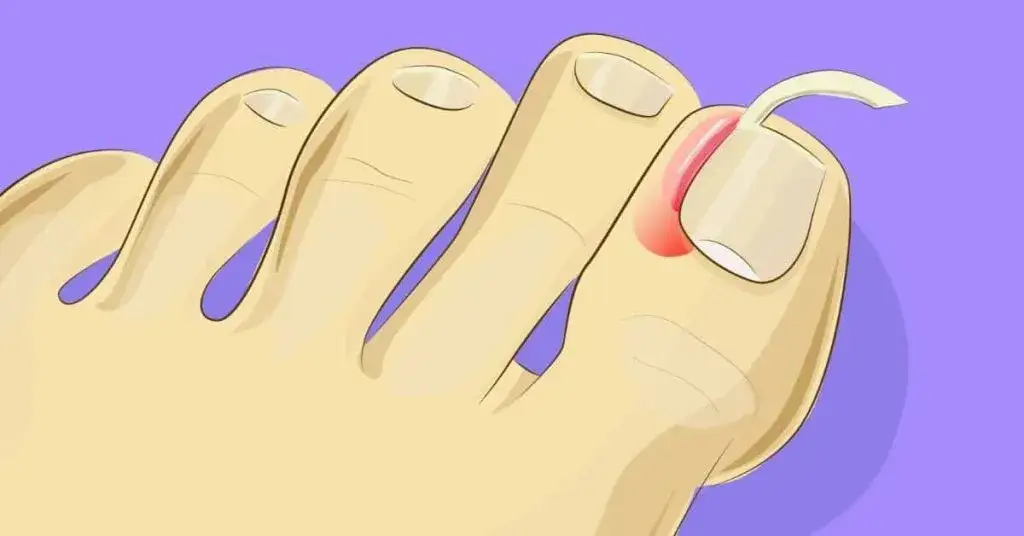 Jak skutecznie poradzić sobie z wrastającym paznokciem – domowe sposoby i leczenie