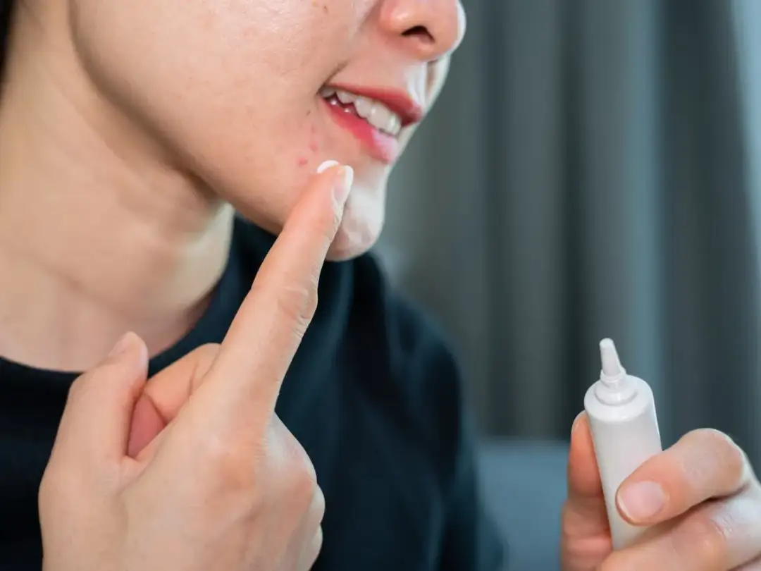 Pasta do zębów na pryszcze? Ile trzymać i dlaczego to mit!