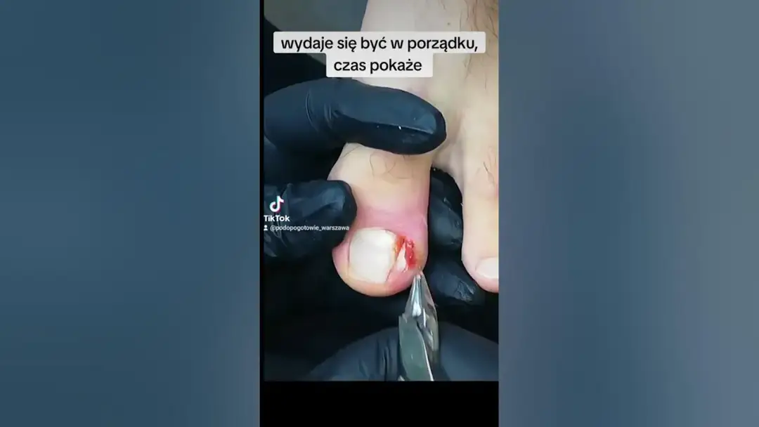Jak wyciąć wrastający paznokieć i uniknąć bólu oraz komplikacji