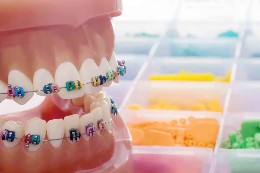 Ruchomy aparat ortodontyczny dziecka: Czy warto? Kompletny poradnik