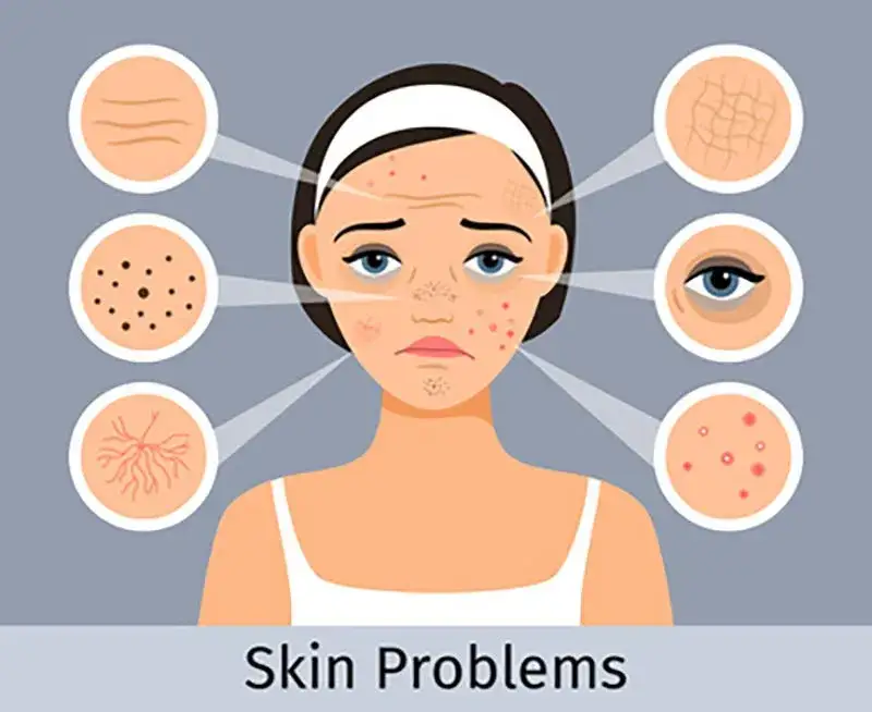 Jak pozbyć się śladów po pryszczach? Kompleksowy przewodnik