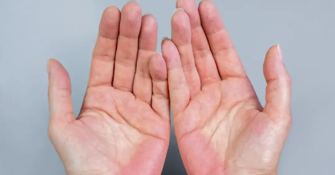 Czerwone dłonie od wewnątrz przyczyny: objawy, które mogą zaskoczyć