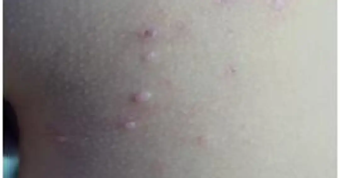 Skuteczne sposoby na mięczaka zakaźnego - 7 najlepszych metod leczenia