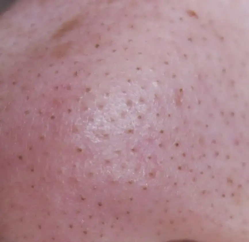 Jak wygląda zapchana cera i jak skutecznie z nią walczyć